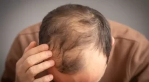 Beslenme ve Kellik Arasındaki Bağ: Şekerli İçecekler Hormonları, Hormonlar Saçları Bozuyor